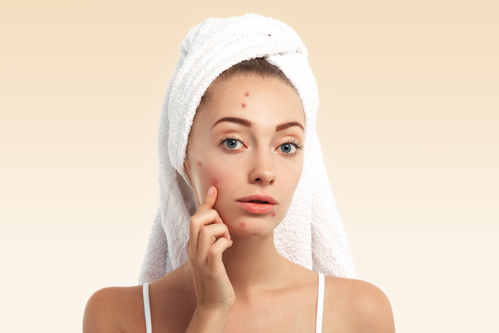 Natural Remedies for Acne
